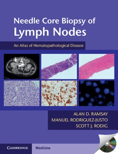 Needle Core Biopsy of Lymph Nodes with DVD-ROM: An Atlas of ...