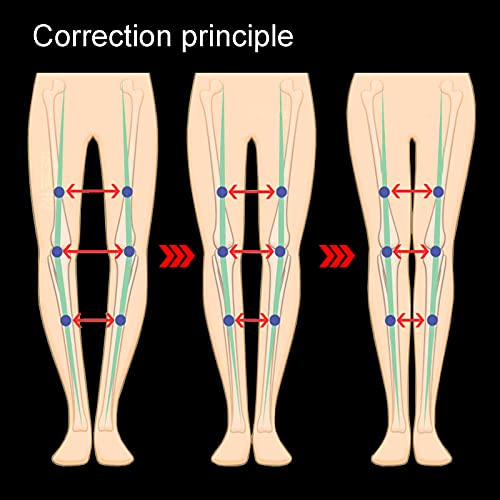 O/X Leg Type Correction Belt,Knock Knee Braces, Belt Posture Corrector Belt Knock Knees Valgus Deformity Bow Legs Band Straighten Belt For Children And Adult Durable Easy To Correct #TOP5