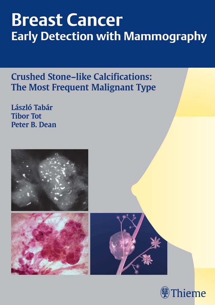 Breast Cancer: Early Detection with Mammography: Crushed Stone-like Calcifications: The Most Frequent Malignant Type (Tabar Mammo)      1st Edition, Kindle Edition