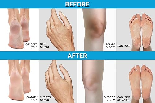 Vista 38 de Clear 40, 40% gel de urea, 8 onzas con aceite de árbol de té y coco, extracto de aloe vera, funciona en callos y callos, hidrata y suaviza talones