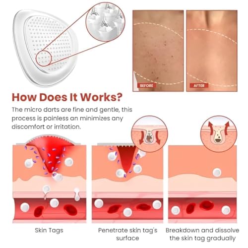 Image of Derma Smooth Skin Tag Removal Patches - 144 Patches | Gentle & Effective Skin Tag Remover for All Skin Types | No Burning or Freezing, Fast and Effective Results, No Scarring | Easy & Pain-Free Application-(Transparent & BOX PACKED)