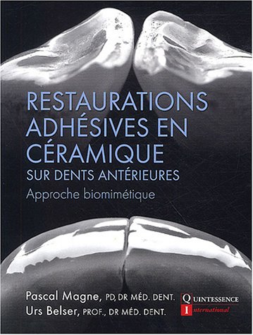 Restaurations Adhésives En Céramique Sur Dents Antérieures (French Edition)