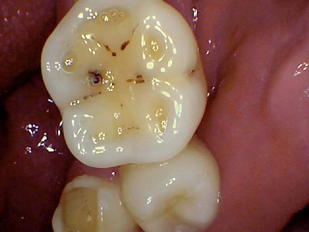 Kamera doustna den-tal, łatwe połączenie USB, kamera wewnątrzustna 2.0, 6 megapikseli, 6-LED, wyraźny obraz do narzędzi dentystycznych