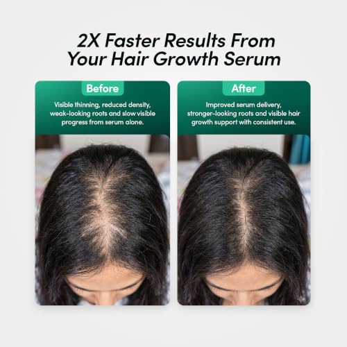Image of NanoInfuser Microneedling Serum Applicator with Adjustable Titanium Needles 0.5mm to 1.5mm for Scalp Beard and Eyebrow Care Hair Growth Serum Absorption Tool