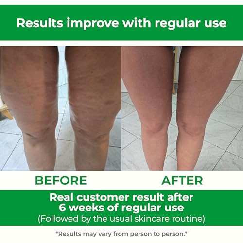 TESMED Cellulite Manual Massager : Made in Italy, Patented with Converging & Diverging Roller Technology. Anti Cellulite Roller for Thighs and Buttock - Image 8