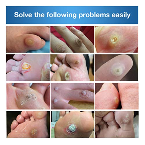 ARTIBETTER 24Pcs Verruga Removedor Removedor de Manchas Medicamentosos E Esconder a Verruga Plantar