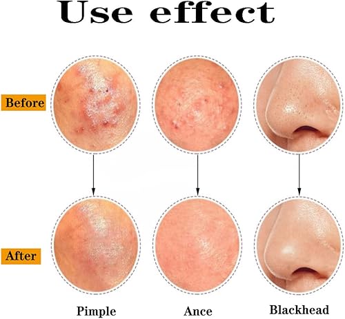 Miniatura 6 de Herramienta profesional para eliminar espinillas, extractor de espinillas, pinzas de eliminación de acné para manchas, estallido de puntos blancos,