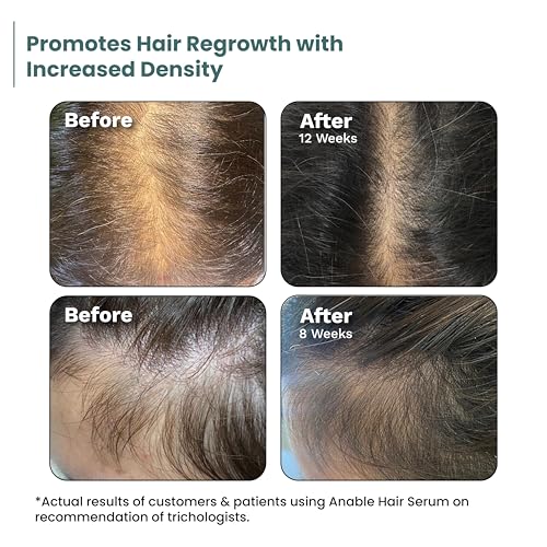 Image of Anable Hair Regrowth Serum- 3% Redensyl, 3% Procapil, 2% Anagain | Hair re-growth & hairfall control serum for man & woman| Clinically tested and safe