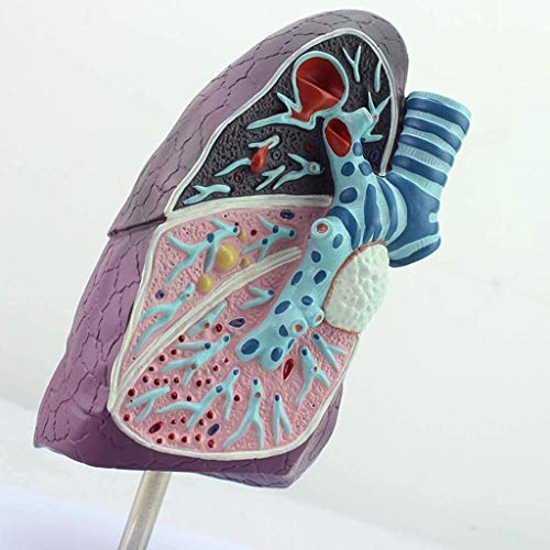 Modèle anatomique du poumon humain pathologique pour expliquer la chirurgie