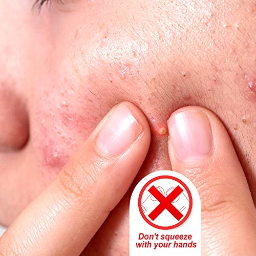 Teenitor Pimple Extractor Acne Treatment Tool Surgical Grade Blackhead Comedone Removal 2-In-1 Popper Tool For Face Nose #TOP5