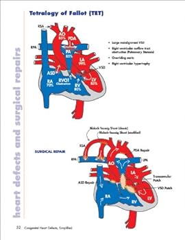 健康・医学 Surgery for congenital heart defects Congenital cardiac surgery: What's next? - Mayo Clinic