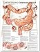 Produktbild Understanding Colorectal Cancer Anatomical Chart