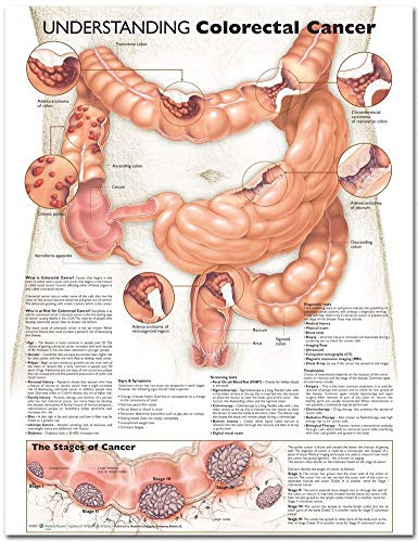Understanding Colorectal Cancer Anatomical Chart