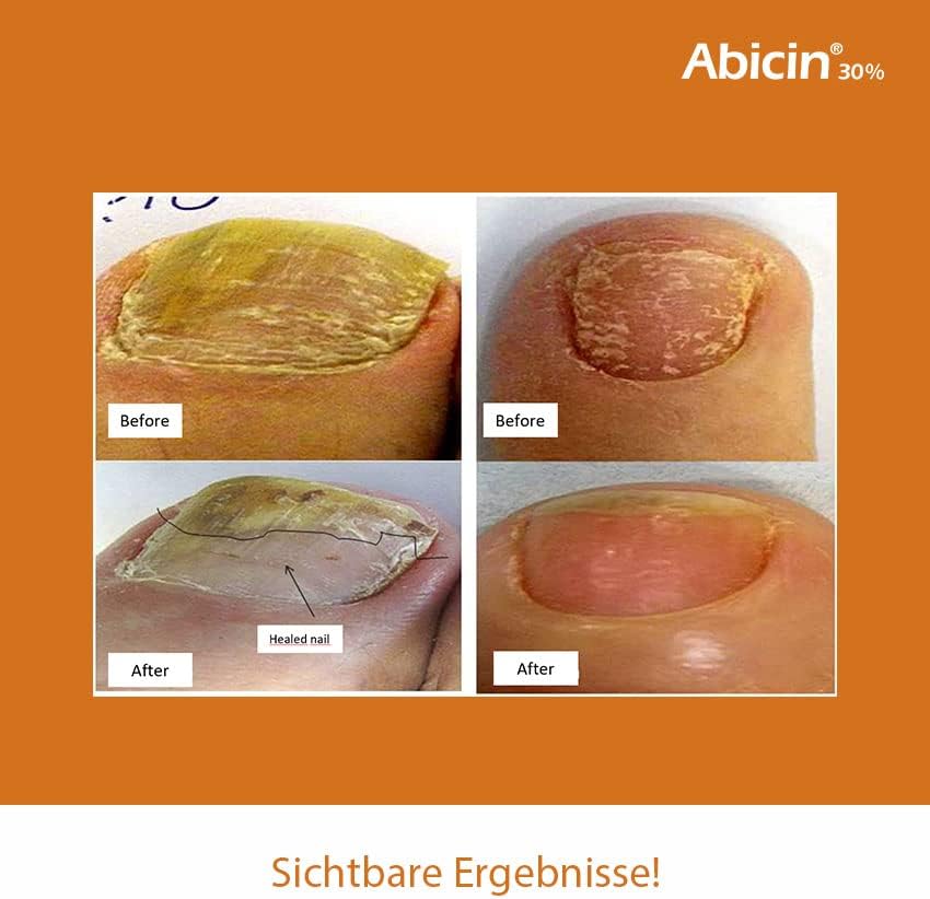 Abicin Fungal Nail Treatment, 10 ml (Pack of 1) - Image 5