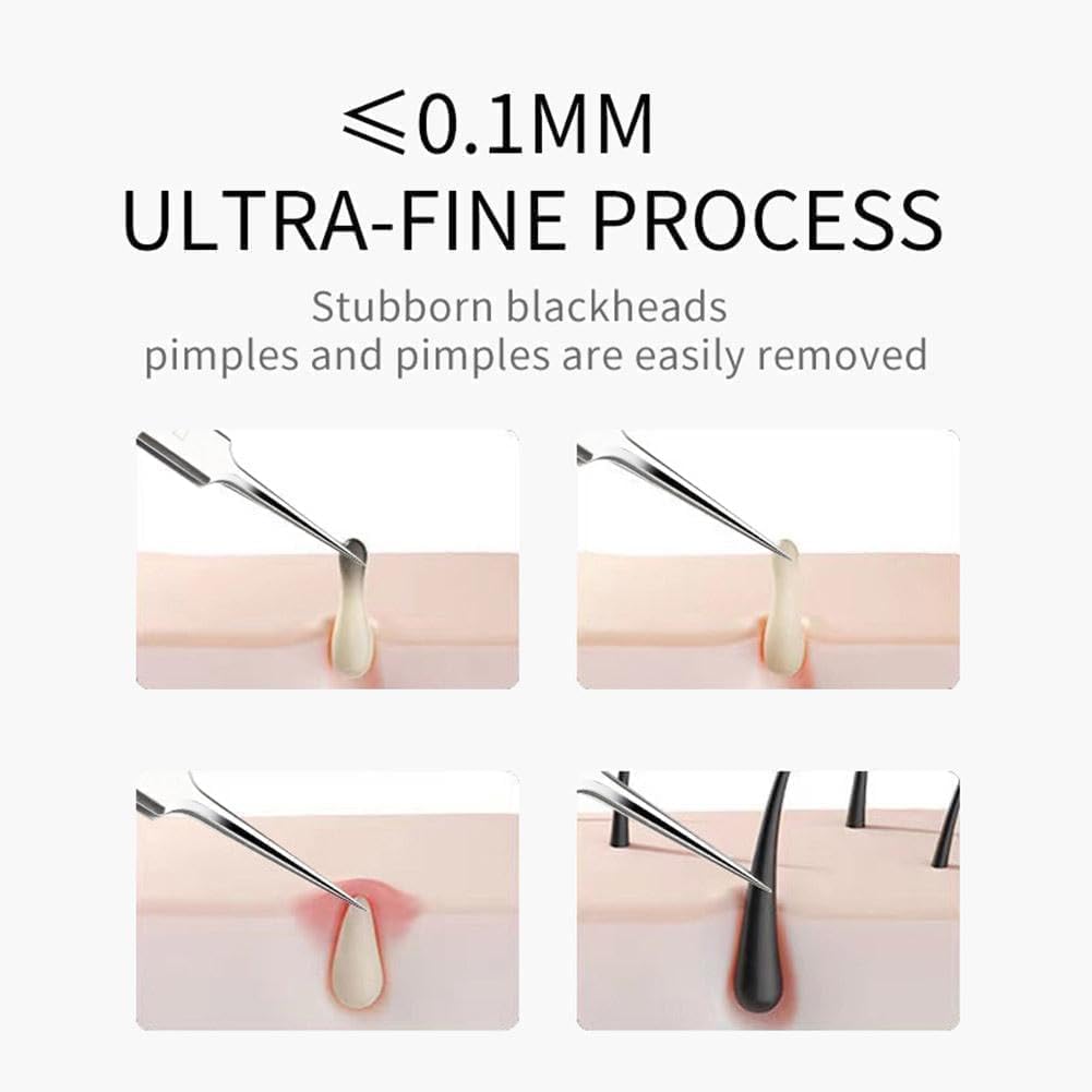 3Pcs Professionele Mee-eter Pincet Professionele Facial Mee-eter Remover Pincet Precisie Extractor Acne Removal Kit Puistje Popper Gereedschap Huidverzorging Gereedschap