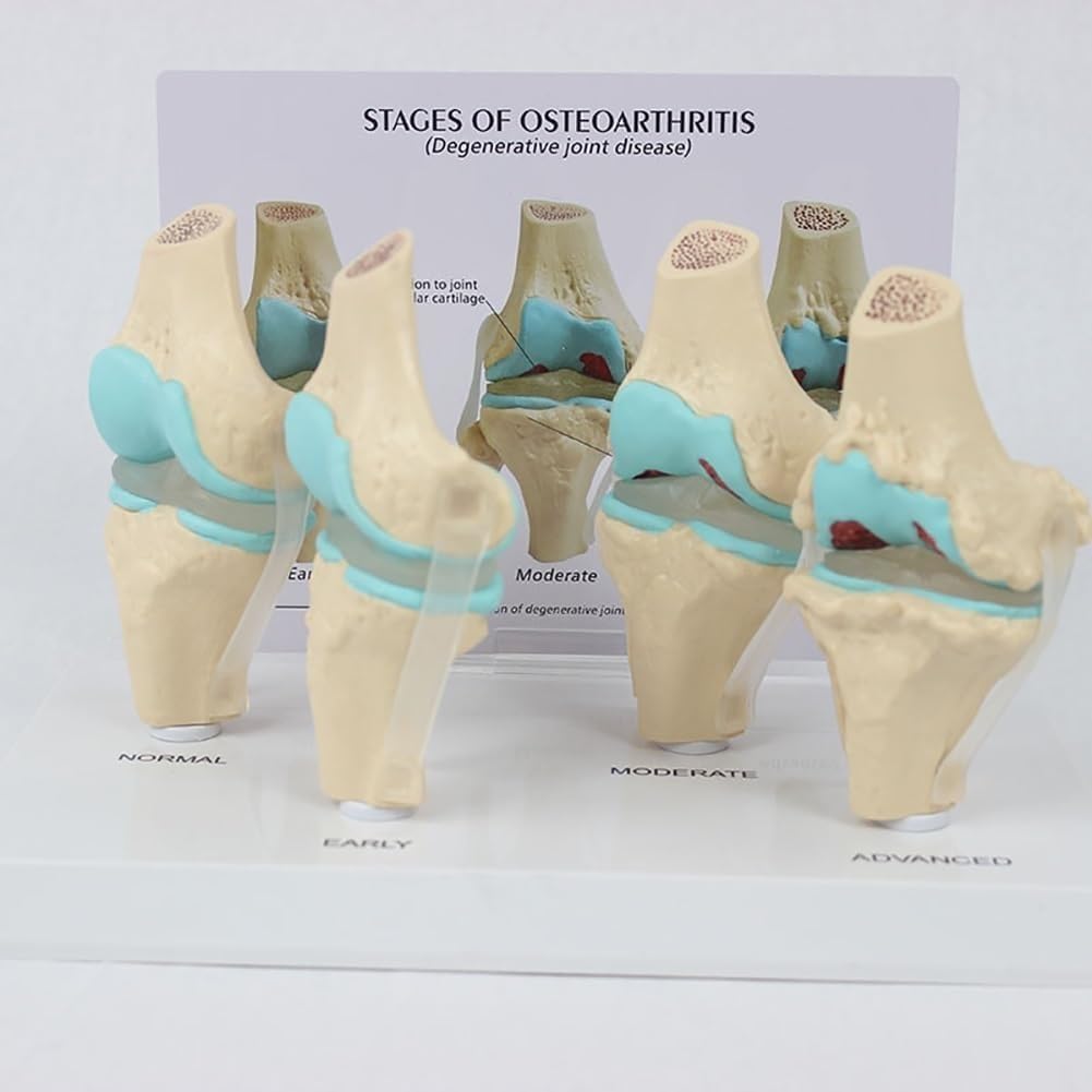 Model anatomiczny choroby zwyrodnieniowej stawów, ludzki 4 stopnie, materiał PCW z podstawą do ekspozycji edukacyjnej w klasach