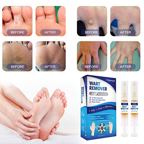 Samsali Wart Remover, Maximum Strength, Easy and Painless Wart Remover, Removing all Kinds of Common Warts, Best Wart Remover for Removing Warts