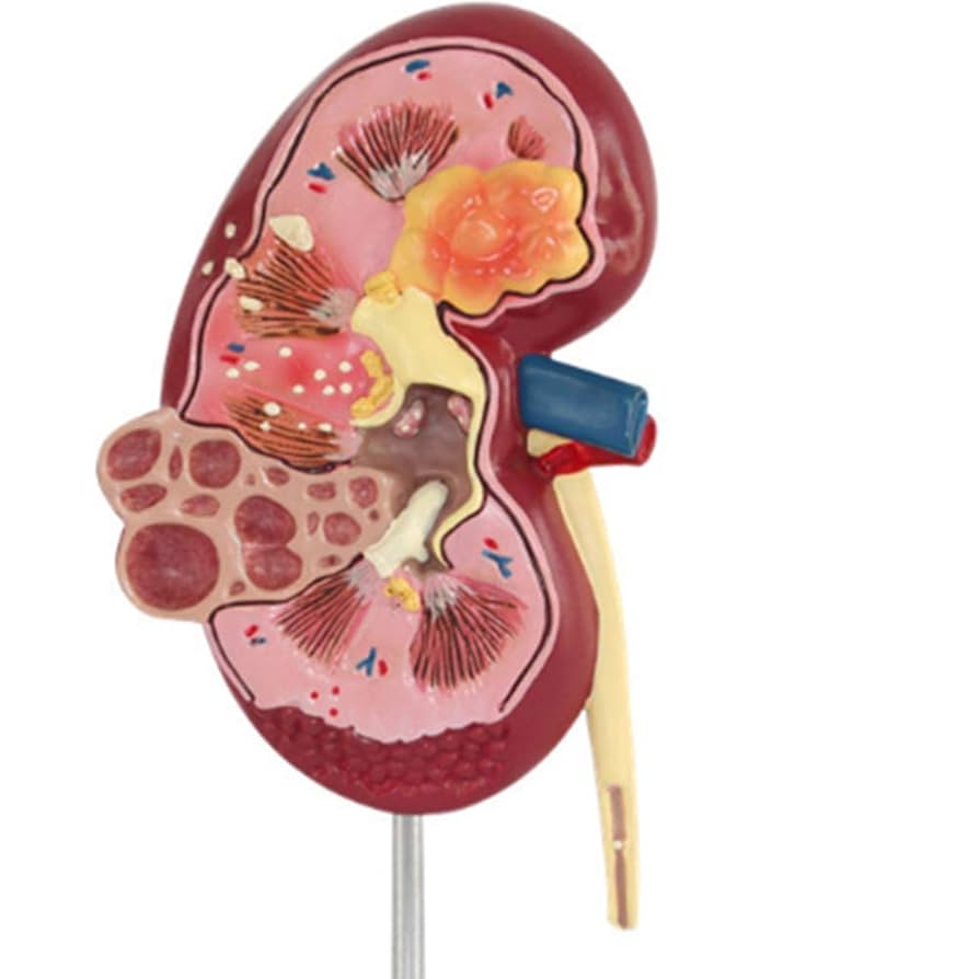 Amazon.co.jp: 腎臓解剖学モデル - 腎臓石 - 腎臓石 - 腎臓石
