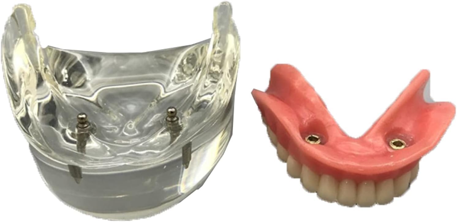 Model dentystyczny - Implant dentystyczny Overdenture Dolna żuchwa 2 Implanty Demo do nauczania i nauki