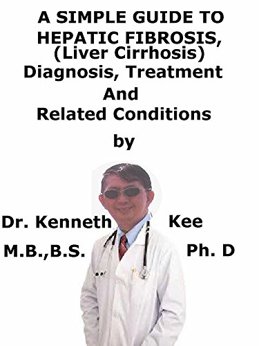 A Simple Guide To Hepatic Fibrosis, (Liver Cirrhosis) Diagnosis, Treatment And Related Conditions