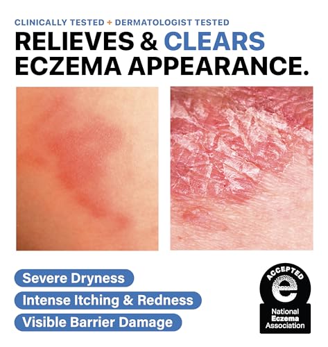 Dr. Arsy Eczema Cream for Adults & Kids – Hypoallergenic Barrier Repair Moisturizer, Clinically Proven (3 Studies), Fragrance-Free, Dermatologist Tested, Face & Body Hydration, NEA Accepted, USA Made