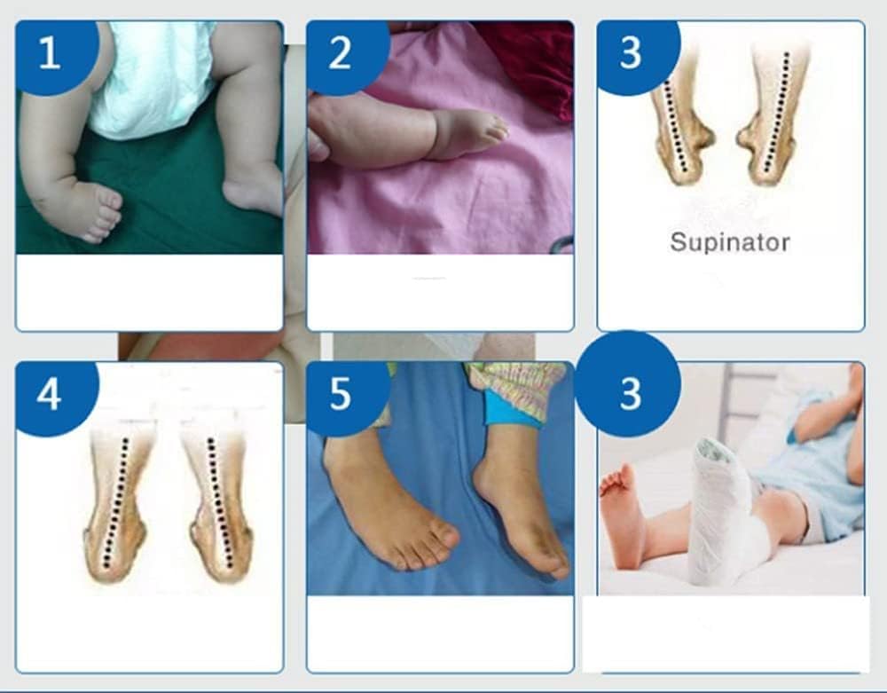 Férula de pie caído para niños, férula nocturna para fascitis plantar y tendinitis de Aquiles, pie derecho o izquierdo, tamaño mediano