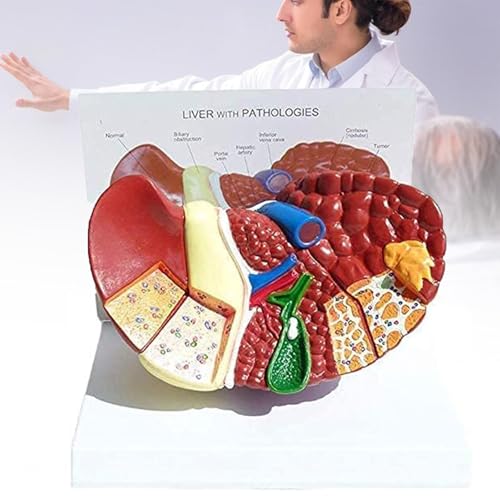 Générique Human Anatomical Model of the Liver with Cirrhosis, for Teaching and Research, Clear and Pathological Texture