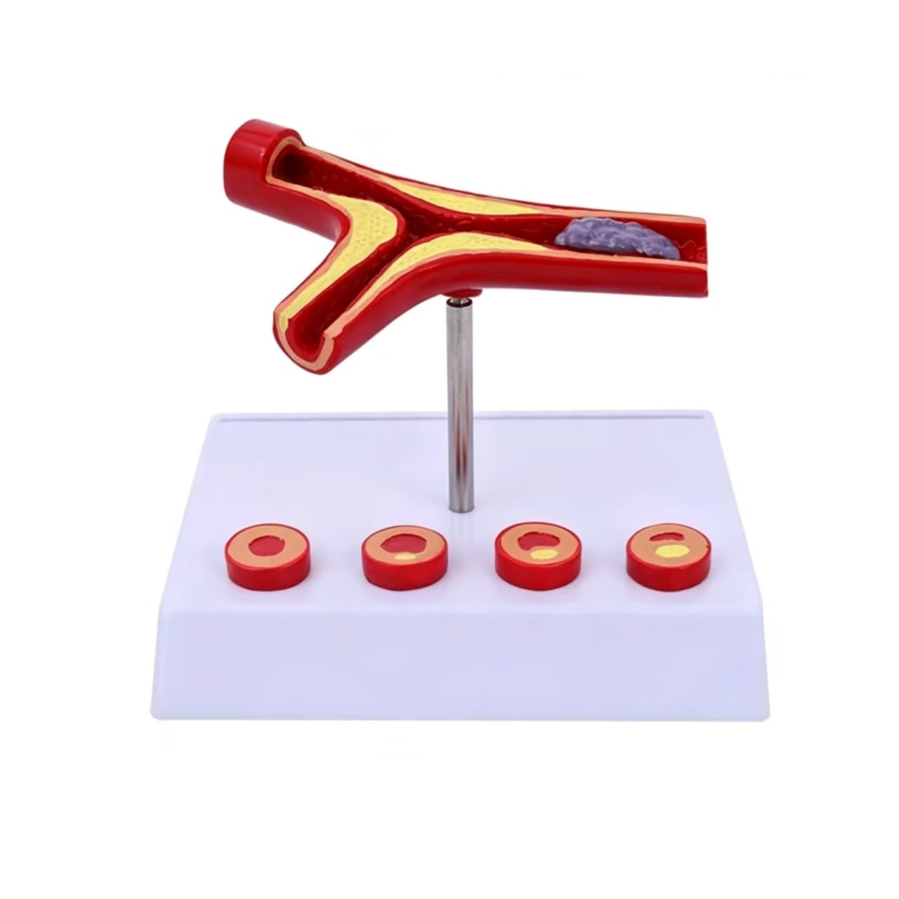 YNIYUJKL Medical Human Atherosclerosis Cardiovascular Model, Blood Vessel Anatomical Models,Vascular Disease Demonstration Tool For Anatomy And Physiology Education