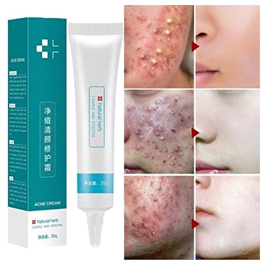 Crema antiacné, 20 g, para eliminar cicatrices de acné, gel blanqueador, hidratante, crema para el cuidado facial, para piel suave y suave