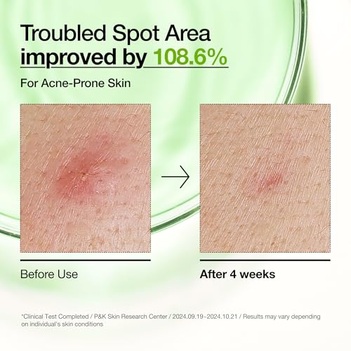 30% Off Anua Azelaic Acid Serum for Blemish-Prone Skin