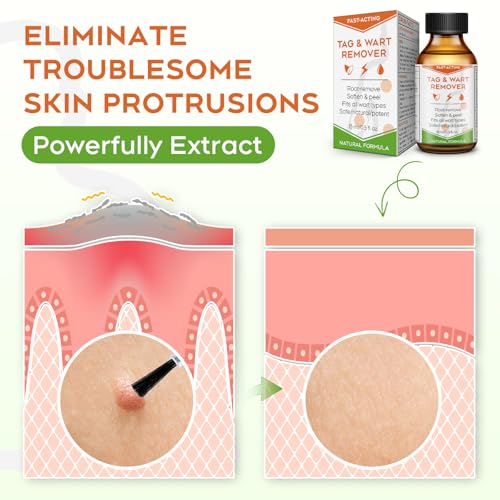Image of inchSTAY STOKED inch Wart Remover, 15 ml Skin Tag Remover Freeze Off - Plantar Wart Remover for Feet with Salicylic Acid - Best Wart Removal for Common Wart-6SZ