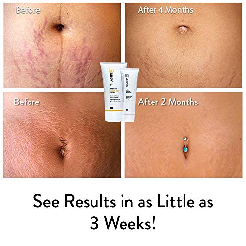 TriLASTIN-SR Intensive Stretch Mark Cream Bundle with Hydro-Thermal Accelerator (5.5 & 3 oz) | Fast-Acting Stretch Marks Cream with Absorption Enhancing Serum | Hypoallergenic & Paraben-free - Image 4