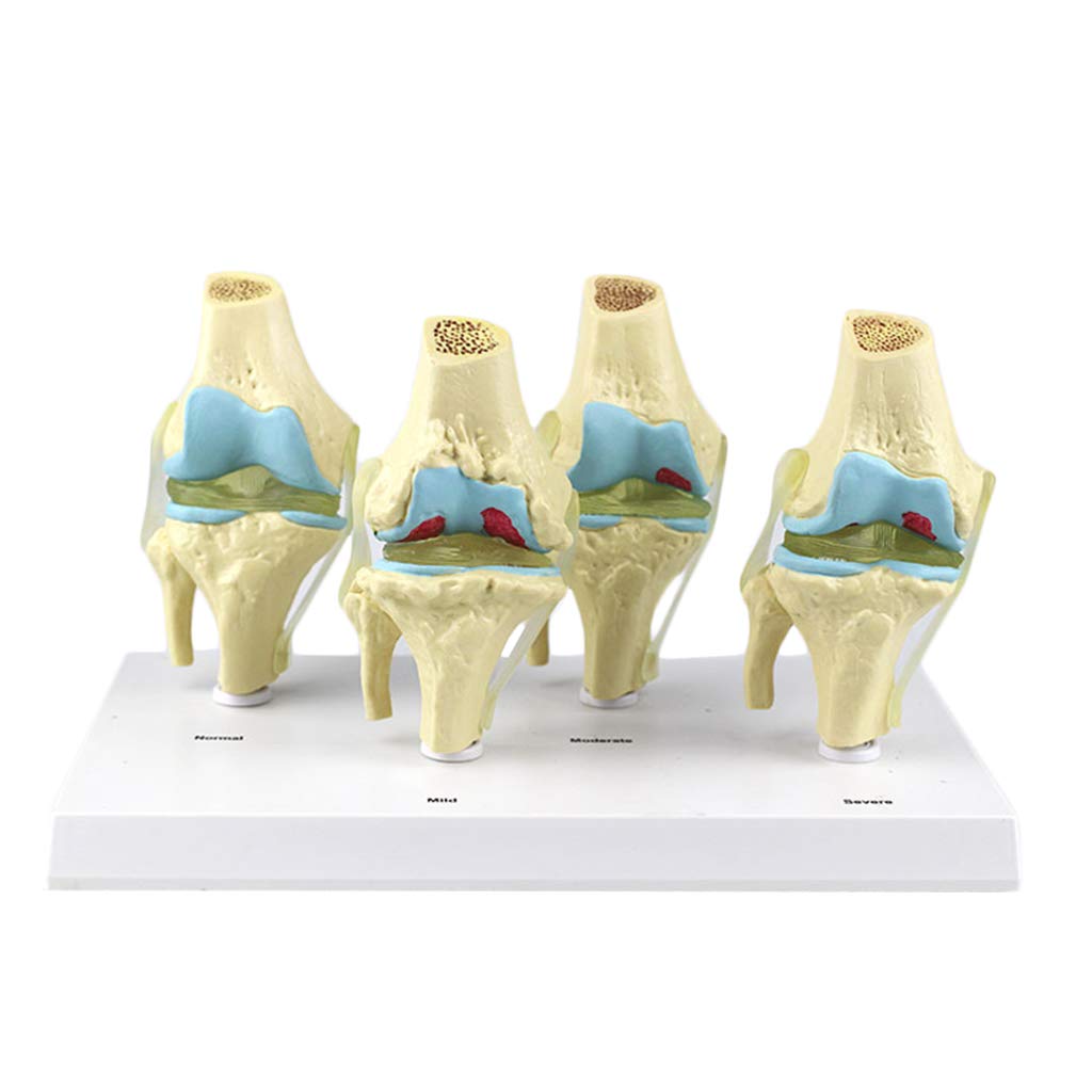 Sjdopulse Four Stage Pathological Knee Joint Model - Human Joint Anatomical Model - Medical Anatomical Knee Joint Model - For Study Display Teaching Medical Model