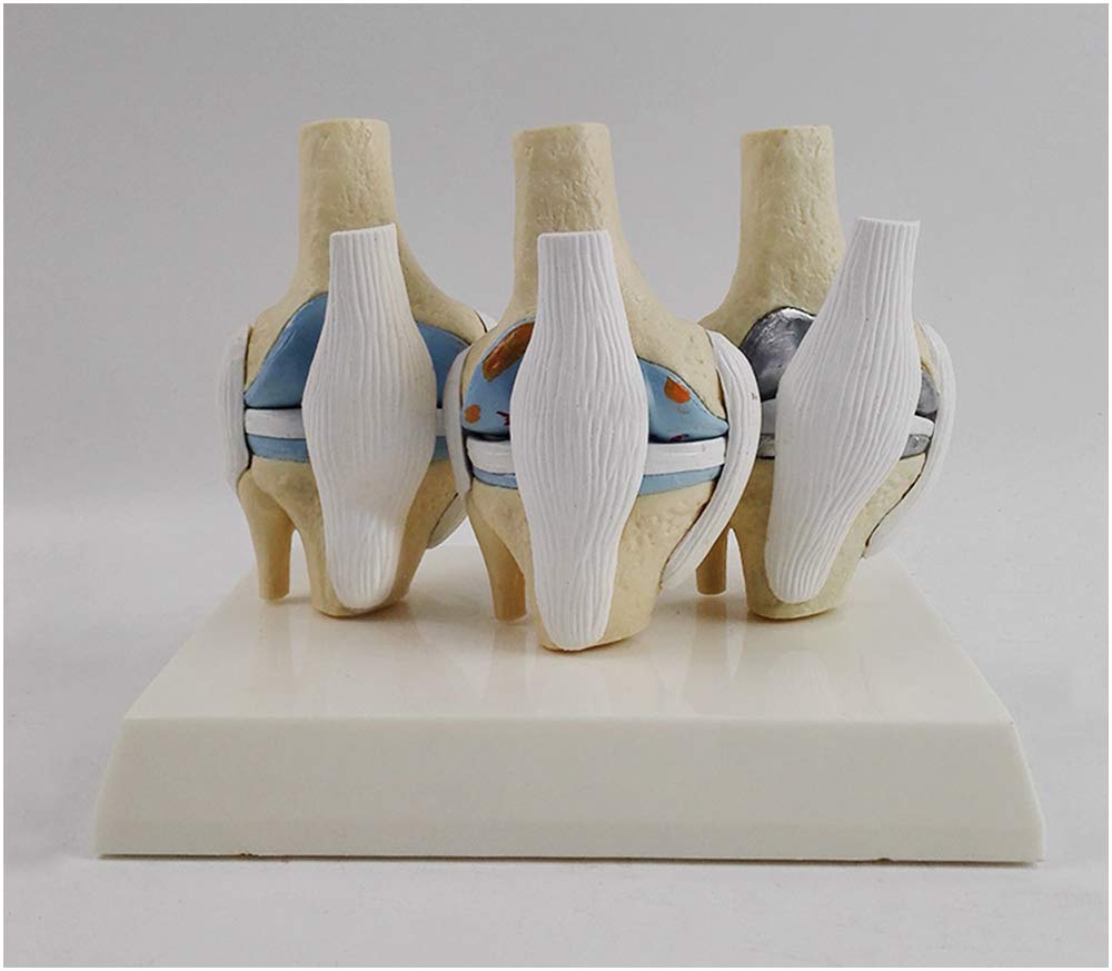 Sjdopulse A Knee Joint Model - Meniscus Cruciate Ligament Knee Joint Model - Human Knee Model With Pathological Joint Ligament - For Study Display Teaching Medical Model (A)