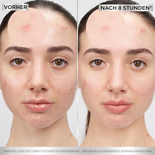 Garnier Hautklar Pimple Patches Invisible, unsichtbare Hydrokolloid Anti Pickel Patches mildern Sichtbarkeit in 8H, XXL Pack mit 44 Stück, gezielt gegen Pickel & Akne 5