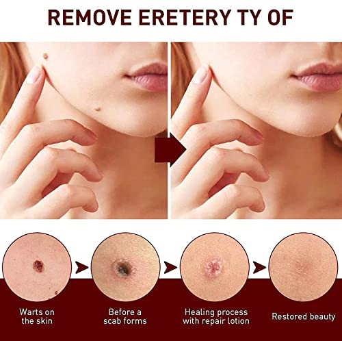 WipeOff Tags & Moles Remover,Wipe off Tags & Moles...