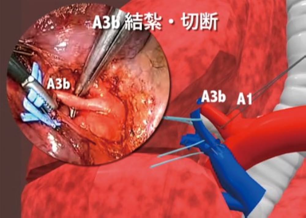 改訂新版　肺切除術 局所解剖と手術手技 肺切除術 ｜朝倉書店