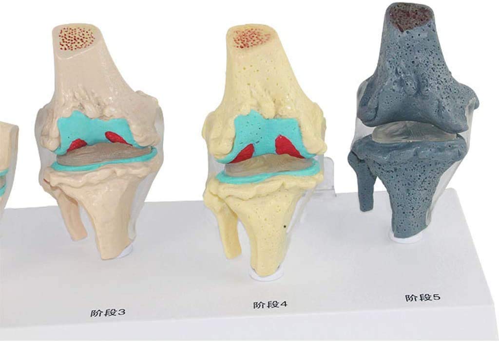 Modèle de blessure au Genou en 6 étapes - Le Genou modèle Anatomique Joint - Affichage de la Science de l'étude en Classe avec des modèles de Rubans et de matériel médical