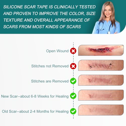 Image of Silicone Scar Sheets, Silicone Scar Tape (1.6 inchx 60 inch Roll-1.5M)