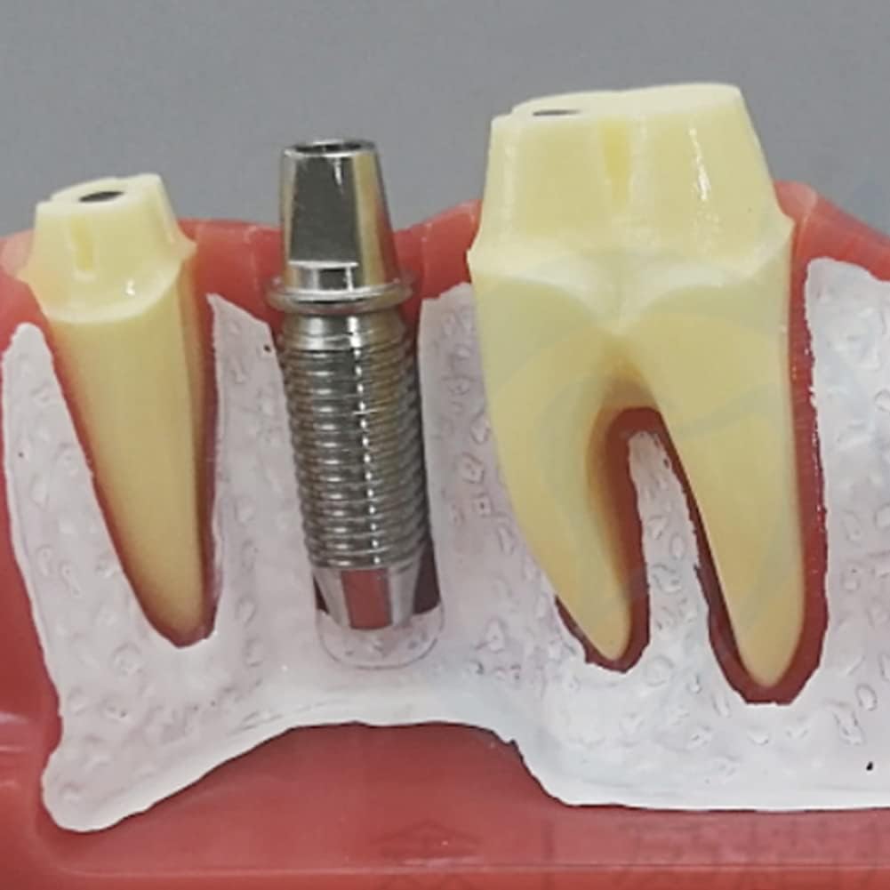 Soluzioni Dentali In Titanio: Corona E Ponte Su Impianto | Kalmar - Foto 11