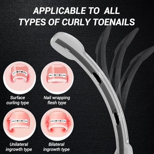 Reieset Titanium Alloy Ingrown Toenail Treatment