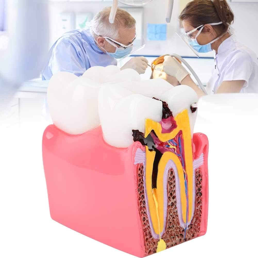 Agatige Modèle D'anatomie Dentaire, Modèles D'Étude De Comparaison De Caries Modèle De Dents D'Éducation À L'anatomie Dentaire De Dentiste Modèle De Développement De Caries Dentaires pour L'Éducation