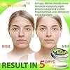 Cystic-Acne-Treatment-and-Acne-Scar-Remover-Made-in-USA-Effective-Face-Body-Severe-Acne-Cleanser-with-Tea-Tree-Oil-Prevent-Future-Breakouts-Natural-Acne-Spot-Pimple-Cream Wellution Cystic Acne Treatment Cream - Natural Pimple and Scar Remover with Tea Tree Oil - Effective Overnight Face Treatment for Acne Spots, Pimples and Scars - 1oz