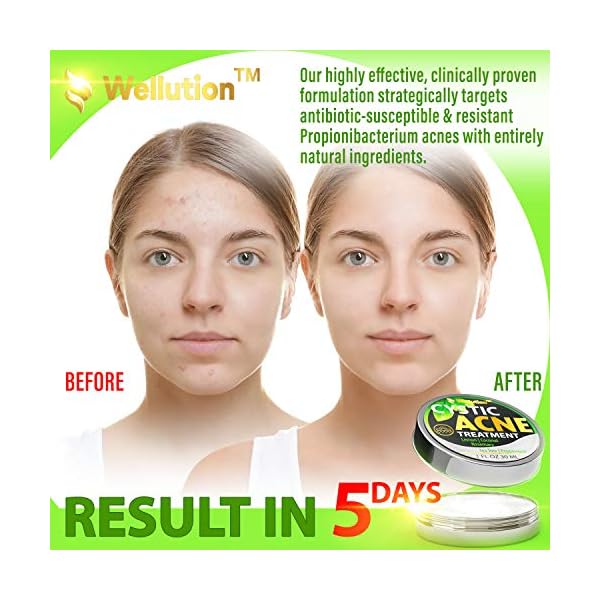 Cystic-Acne-Treatment-and-Acne-Scar-Remover-Made-in-USA-Effective-Face-Body-Severe-Acne-Cleanser-with-Tea-Tree-Oil-Prevent-Future-Breakouts-Natural-Acne-Spot-Pimple-Cream Wellution Cystic Acne Treatment Cream - Natural Pimple and Scar Remover with Tea Tree Oil - Effective Overnight Face Treatment for Acne Spots, Pimples and Scars - 1oz