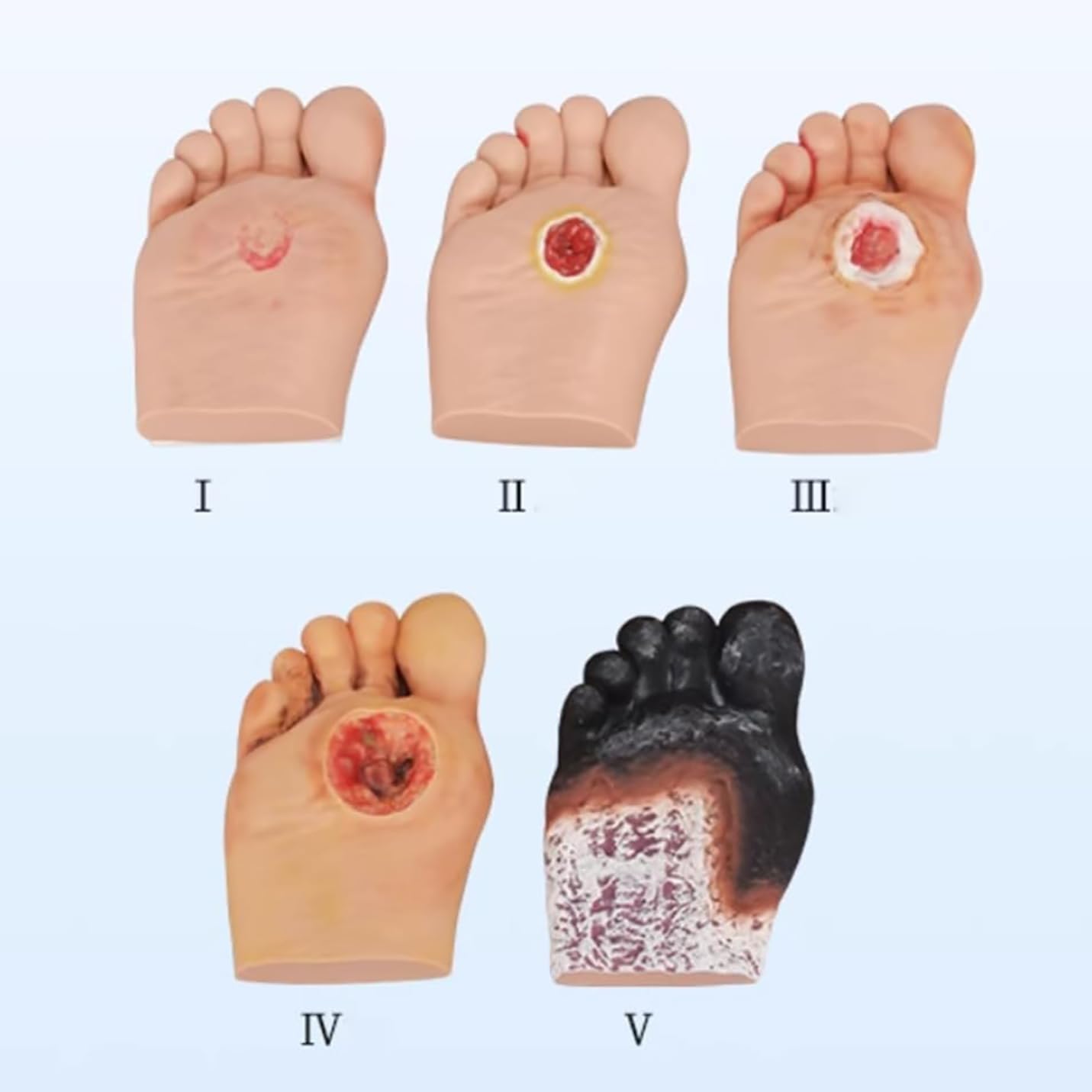 Model symulatora stopy cukrzycowej do demonstracji pielęgnacji ran, stopnia 1-5, ropne zmiany ran, narzędzie do anatomii i fizjologii, idealny do edukacji medycznej