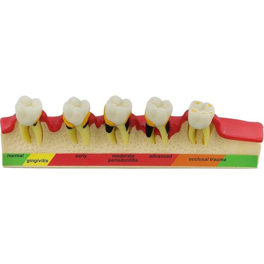 Lpitoy Colorful Teeth Periodontal Disease Model Dental Caries Breakdown Display Model Teaching Tooth Model Perio Disease Assort Demo
