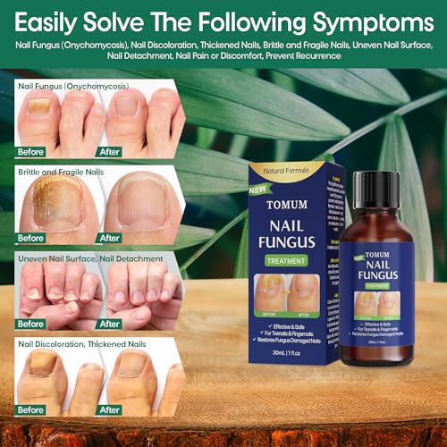 Toe finger nail fungal treatment: hongos fungal remover extra strength liquid - repair damaged nail with brush (30ml/1fl oz) - Thumbnail 3