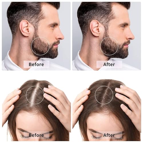 Image of LEAFED 0.5 mm Derma Roller For Hair Growth With 540 Titanium Alloy Needles With Scalp Massager Shampoo Brush | Repairs Damaged Hair, Activates Hair Follicles | Roller for Beard & Hair Growth & Reduces Acne Scars