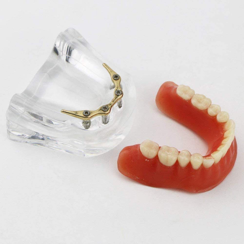 Restauración De Modelo con 4 Implantes Dentales, Implantes De Precisión De Demostración Inferior Modelo De Los Dientes Prótesis Dental, Restauración Protésica Decoración