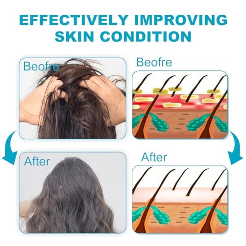 Dry Scalp Shampoo Folliculitis Shampoo, Seborrheic Dermatitis Shampoo, Anti Dandruff Shampoo, Folliculitis Treatment, Dandruff Treatment, with Herbal Essence to Hydrate Hair, Relieve From Itchy - Image 6